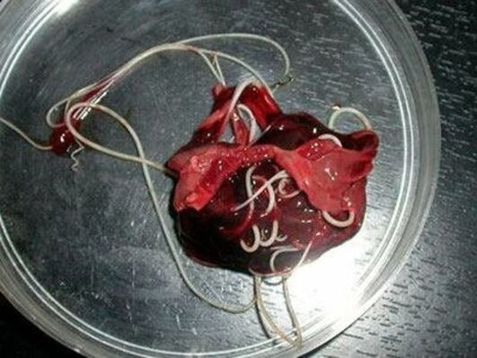 vermi dal corpo umano