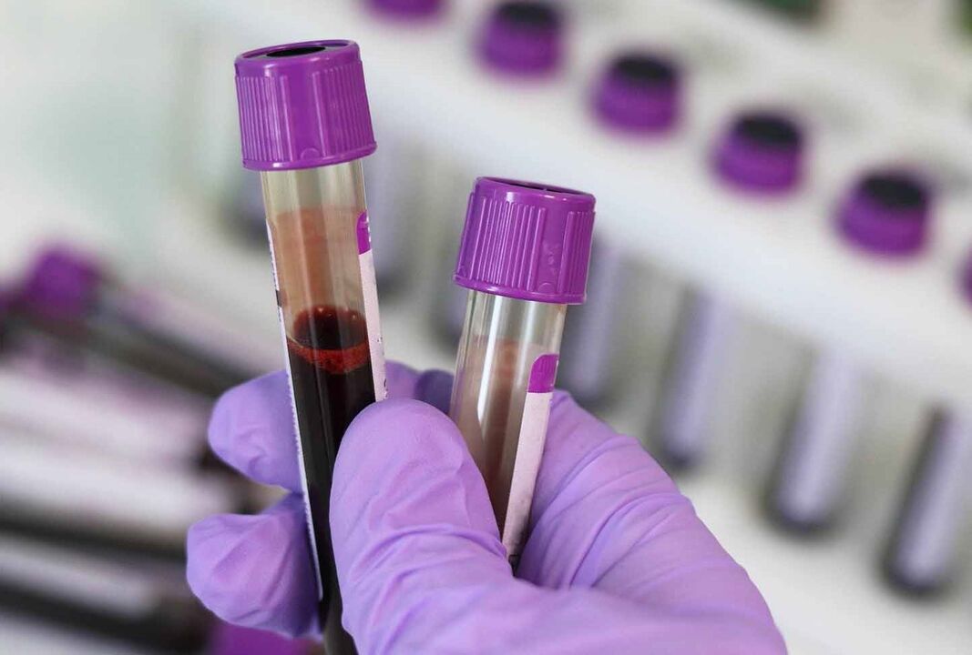 esame del sangue per i parassiti